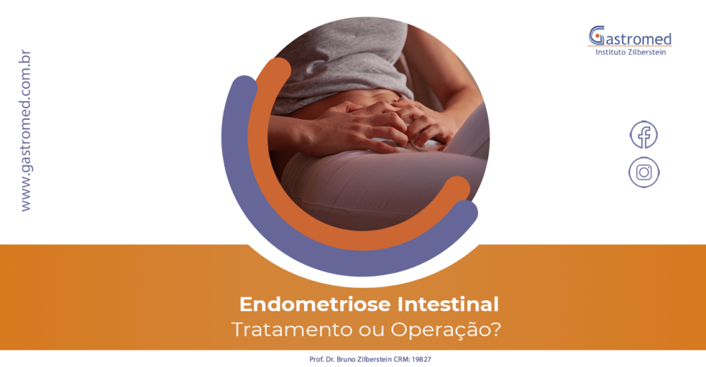 Endometriose Intestinal: Tratamento ou Operação? | Gastromed