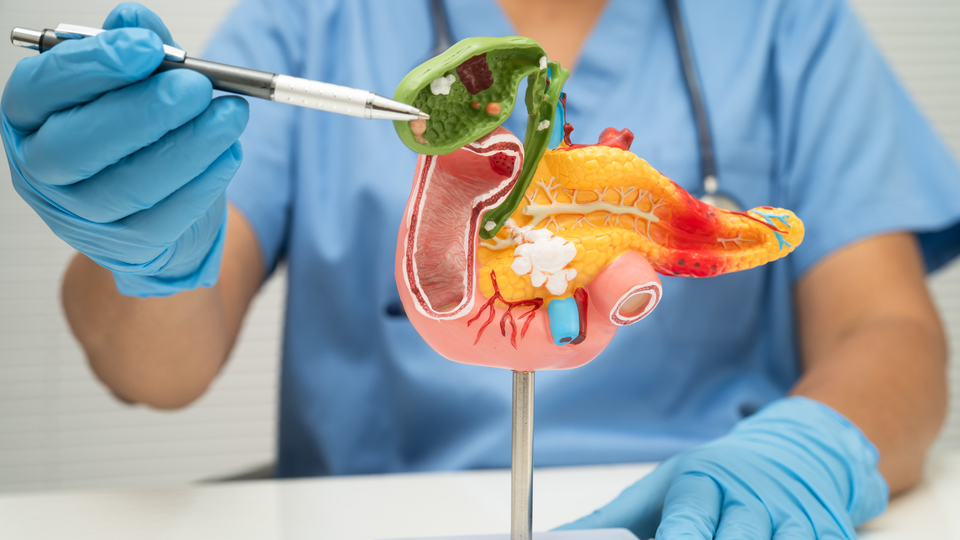 Colangite 6 Sintomas, Causas e Tratamento da Infecção Biliar | Gastromed