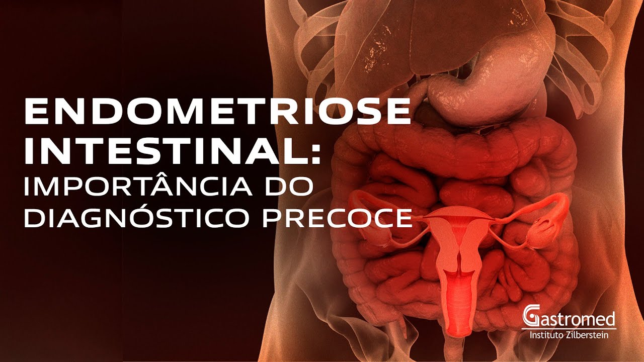Endometriose Intestinal: 7 Sintomas, Diagnóstico Precoce e Tratamento | Gastromed