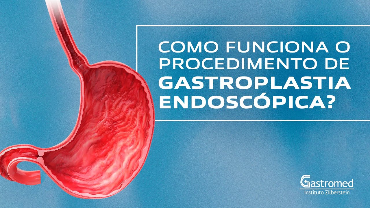 Gastroplastia Endoscópica: Como Funciona, 5 Indicações e Resultados | Gastromed