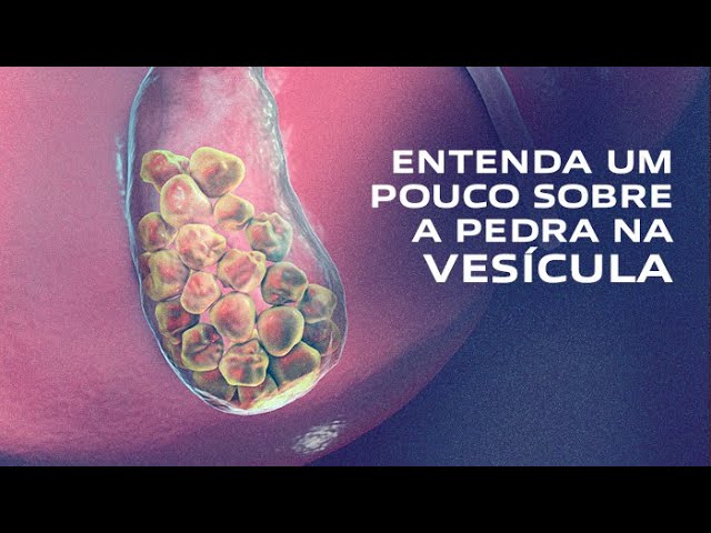 Pedra na Vesícula (Colelitíase) - 8 Fatores de Risco, Sintomas e Tratamento | Gastromed